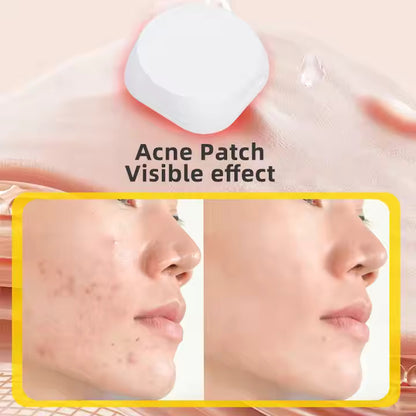 Electronic Acne Patch | Eliminates Pimple and Acne-6 pcs